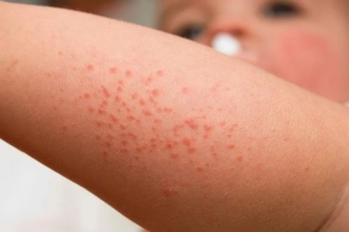 Cách điều trị rôm sảy ở trẻ nhỏ