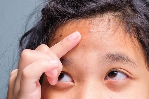 Cần làm gì khi trẻ bị mụn trứng cá?