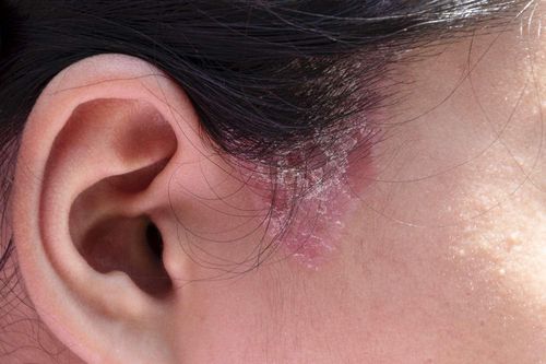 Bệnh nấm da đầu có lây qua tiếp xúc?