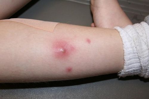 Dấu hiệu mụn nhọt bị nhiễm trùng