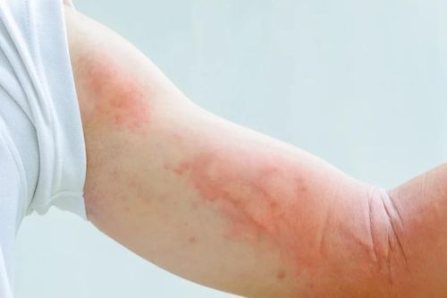 Bệnh mề đay có lây không?
