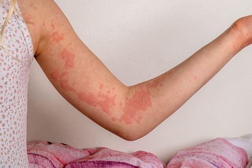 Dấu hiệu cần nhập viện khi bị dị ứng thức ăn