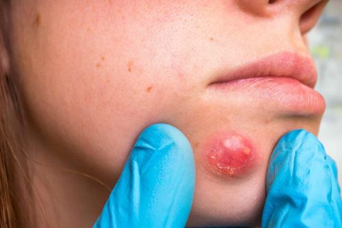 Hai cách điều trị mụn nhọt tại nhà