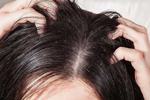 Lựa chọn dầu gội khi bị nấm da đầu