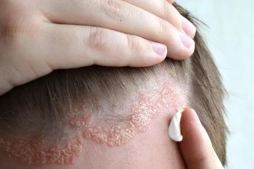 Nấm da đầu có lây không?