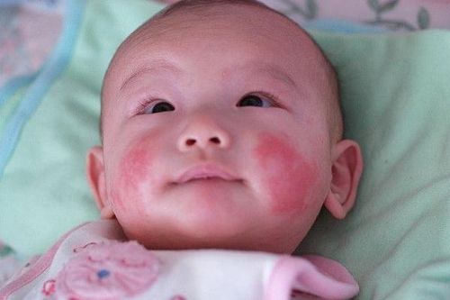 Làm sao để xóa vết bớt trên mặt trẻ?