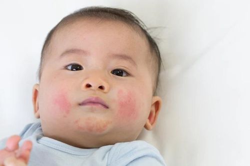 Nguyên nhân gây chàm sữa ở trẻ
