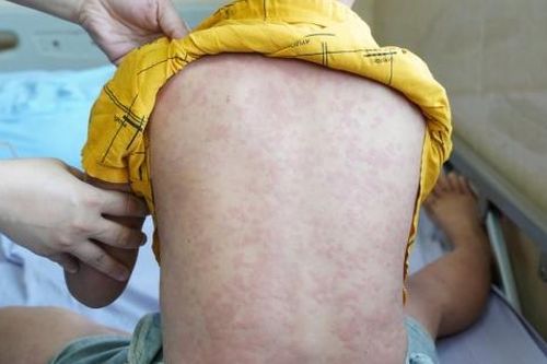 Bé trai nhập viện khẩn cấp do mày đay nhiễm khuẩn