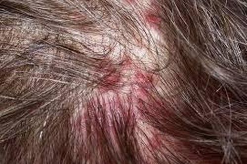Tự chích mụn mủ trên da đầu có được không?