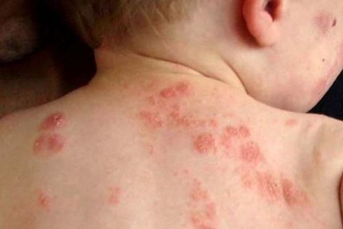 Các loại chàm thường gặp và đối tượng dễ mắc