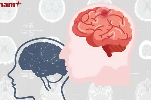Đột phá mới: Kéo dài thời gian sống cho bệnh nhân mắc u não ác tính