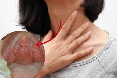 Thành họng nổi cục, nổi hạt có phải bị ung thư họng không?