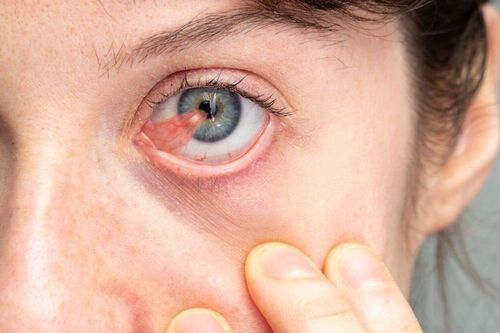 Mộng thịt ở mắt có nguy hiểm không?
