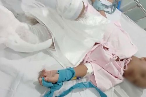 Làm rõ vụ bé trai nghi bị cha tạt nước sôi