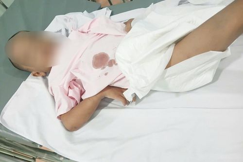 Bé 6 tuổi ở TP.HCM nghi bị bạo hành đến tổn thương gan, nhiễm trùng vết bỏng