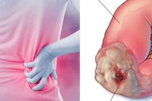 Sụt cân nhanh có phải ung thư thận?