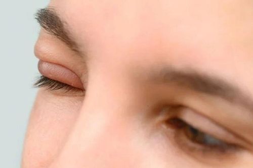 Làm gì khi mắt bị lẹo?
