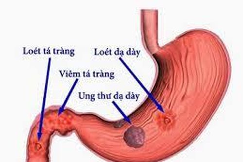 Làm cách nào để tầm soát ung thư dạ dày khi gia đình có người bị bệnh?