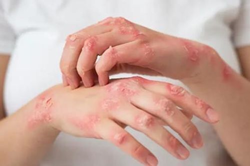 Thuốc điều trị bệnh ghẻ