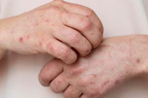 10 dấu hiệu cảnh báo bệnh tim xuất hiện trên làn da
