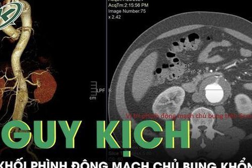 Cứu sống bệnh nhân có khối phình động mạch chủ bụng khổng lồ