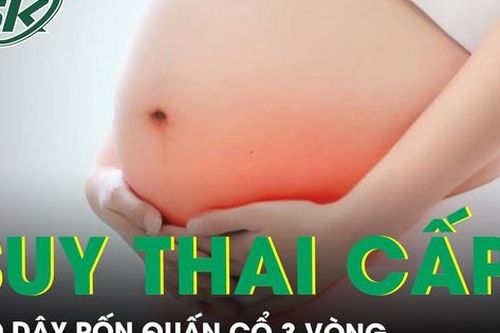Suy thai cấp trong chuyển dạ do dây rốn quấn cổ 3 vòng