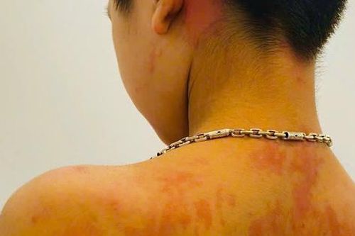 Trẻ 7 tuổi ở Hà Giang sốc phản vệ vì thói quen nhiều cha mẹ Việt hay làm mỗi khi bị ho