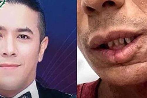 Căn bệnh khiến ca sĩ Kasim Hoàng Vũ biến dạng mặt có nguy hiểm tới tính mạng không?