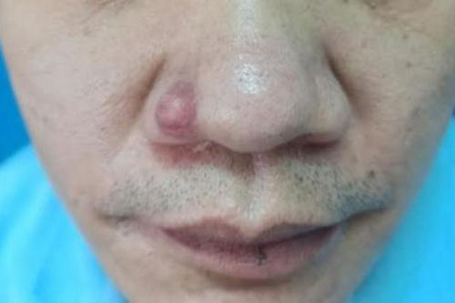 Khối u nhỏ cảnh báo bệnh ung thư hiếm gặp