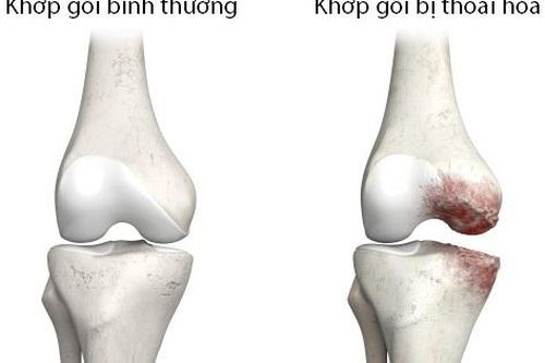Điều trị bệnh thoái hóa khớp gối như thế nào?