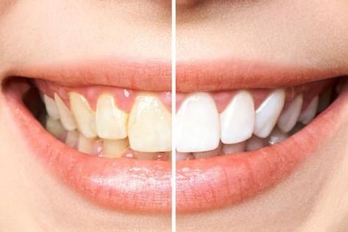 10 lý do khiến răng bị ố vàng