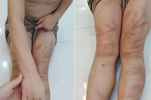 Làm rõ vụ việc 6 trẻ mầm non bị đánh bầm tím khắp cơ thể