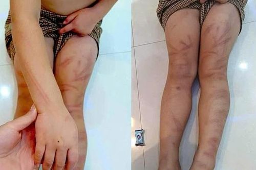 Nghệ An: Nhiều trẻ mầm non 5 tuổi bị bạn học đánh bầm tím người