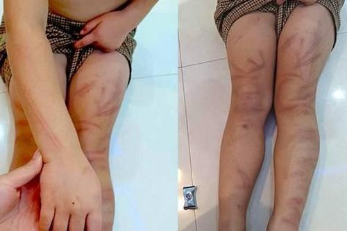 Thông tin mới vụ 6 trẻ mầm non ở Nghệ An bị đánh bầm tím người