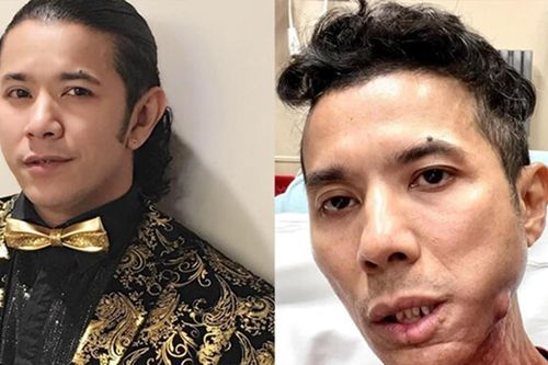 Sức khỏe Kasim Hoàng Vũ tiến triển tốt, đang chờ lịch phẫu thuật