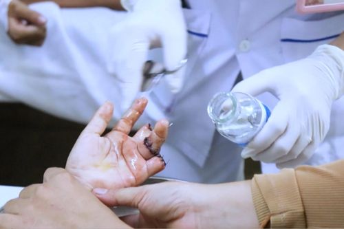 Nối ngón tay bị đứt lìa cho bé trai 6 tuổi bị tai nạn sinh hoạt