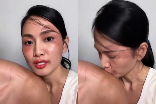 Siêu mẫu Anh Thư gây xôn xao với gương mặt bầm tím khi ngồi cạnh bạn trai