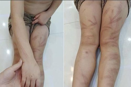 Vụ trẻ mầm non bị đánh bầm tím người: Trường học có động thái bất ngờ