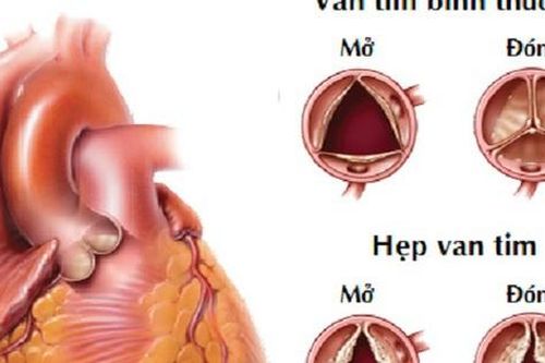 Dấu hiệu sớm bệnh tim bẩm sinh ở trẻ