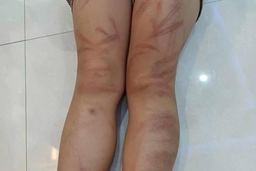 Nghệ An: Tạm đình chỉ giáo viên quản lý lớp vụ trẻ mầm non bị đánh