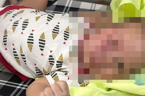 Công an vào cuộc vụ cháu bé 3 tháng tuổi bị đánh bầm tím mặt