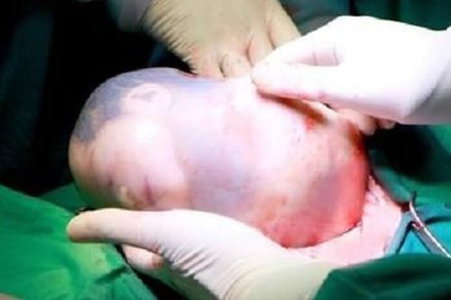 Hai bé song sinh chào đời, 1 bé còn nguyên trong 'bọc điều'