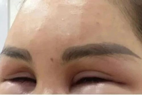 'Tiền mất, tật mang' sau khi tiêm meso