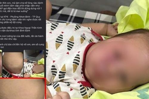 Vụ cháu bé 3 tháng tuổi nhập viện nghi bị bạo hành, công an phường vào cuộc