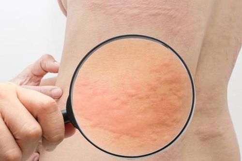 Giao mùa bị nổi mề đay nên làm gì để giảm ngứa mề đay nhanh tại nhà?