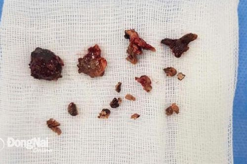 Cô gái trẻ hay bị nghẹt mũi, đau đầu, đi khám phát hiện nhiều sỏi lớn hiếm gặp trong hốc mũi