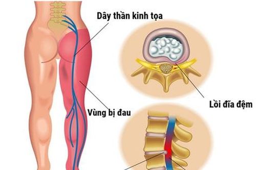 4 bài tập kéo giãn giảm đau thần kinh tọa