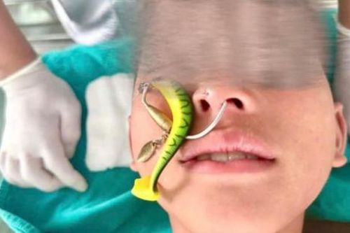 Bé trai 10 tuổi bị móc câu sắc nhọn găm vào mũi