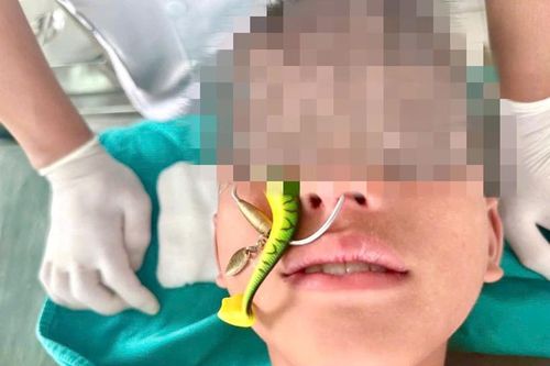 Đi câu cùng bạn, bé trai 10 tuổi bị lưỡi câu găm vào mũi