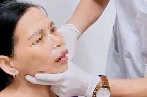 Người phụ nữ 56 tuổi ở Tuyên Quang trật khớp thái dương hàm chỉ vì... ngáp